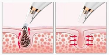 White / Blackhead Pneumatic Extractor (Gentleair)